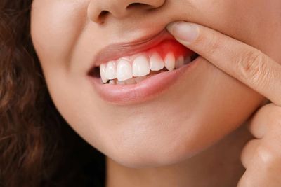 gums treatment in rohini