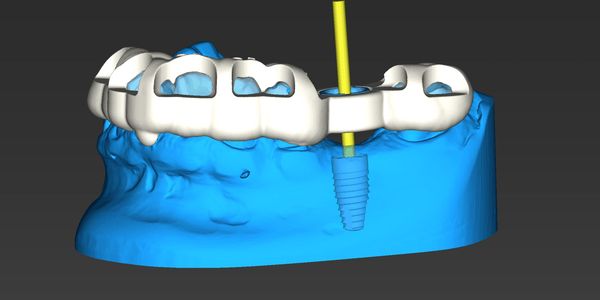 surgical guide for implant placement