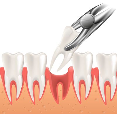 Extraction of tooth