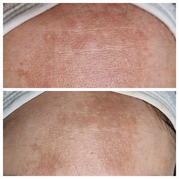 PRX-T33 Biorevitalization Skin Peel