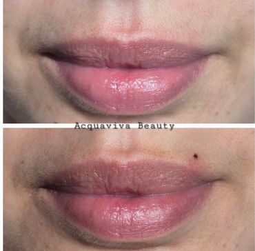 Before and After Cute Beauty Spot Tattoo