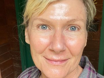 After first Hydrafacial