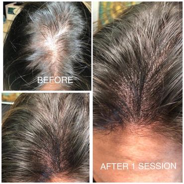 Before & After Female Hair Resoration