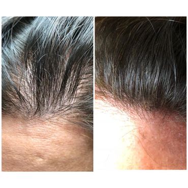 Before & After Female Hair Restoration