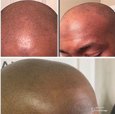 Before & After Male Hair Restoration