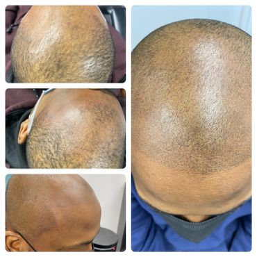 Before & After Scalp Micropigmentation