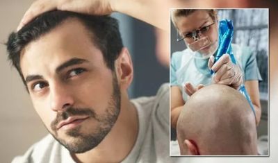 Hair Restoration Services in Rochester NY