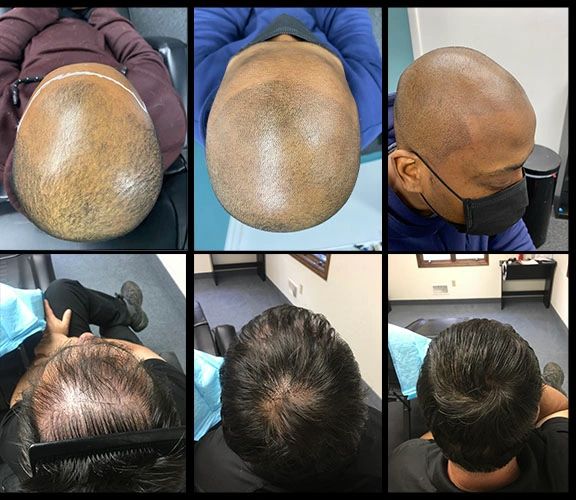 Hair Restoration Rochester