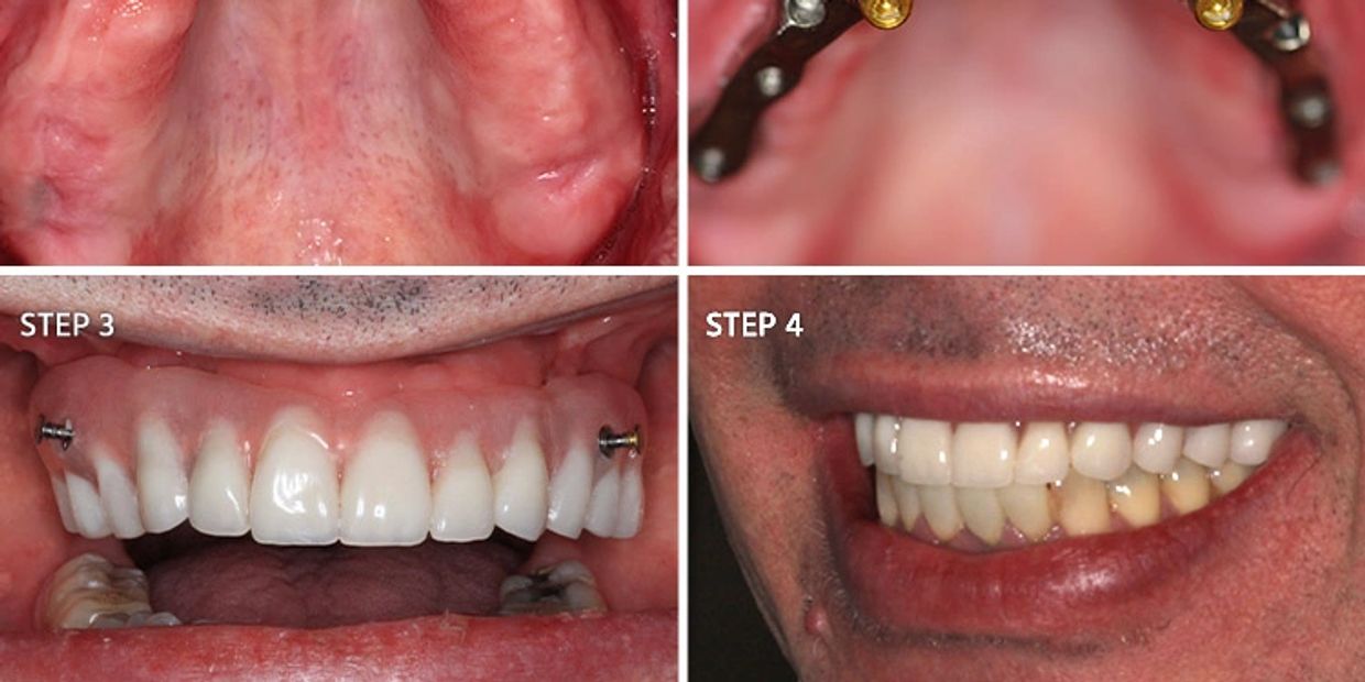 Images of teeth and dental implants 