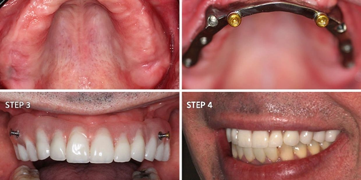 Images of teeth and dental implants 