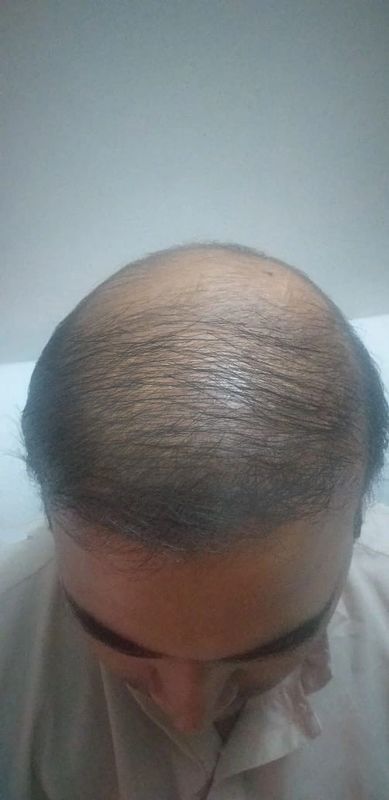 FUE Hair Transplant FUE Hair Transplant