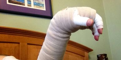 Compression bandages on a lymphedema arm and hand