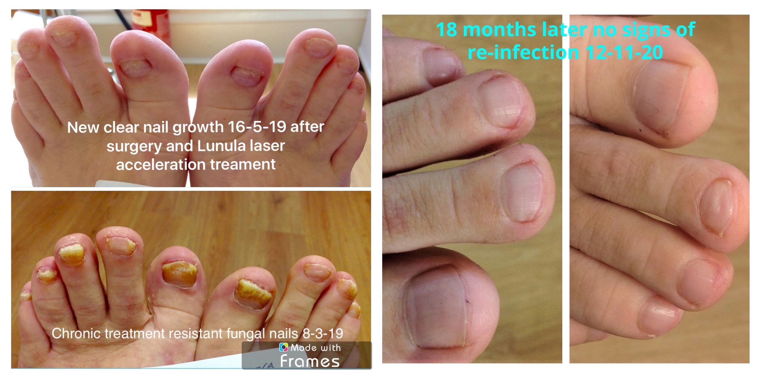 Tinea unguium infection, nail fungus treatment at home