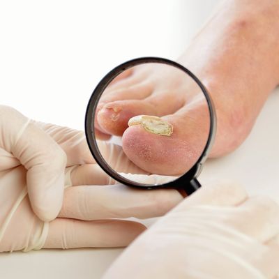 Common Nail Conditions | Hampshire Cure Fungal Nail Clinic