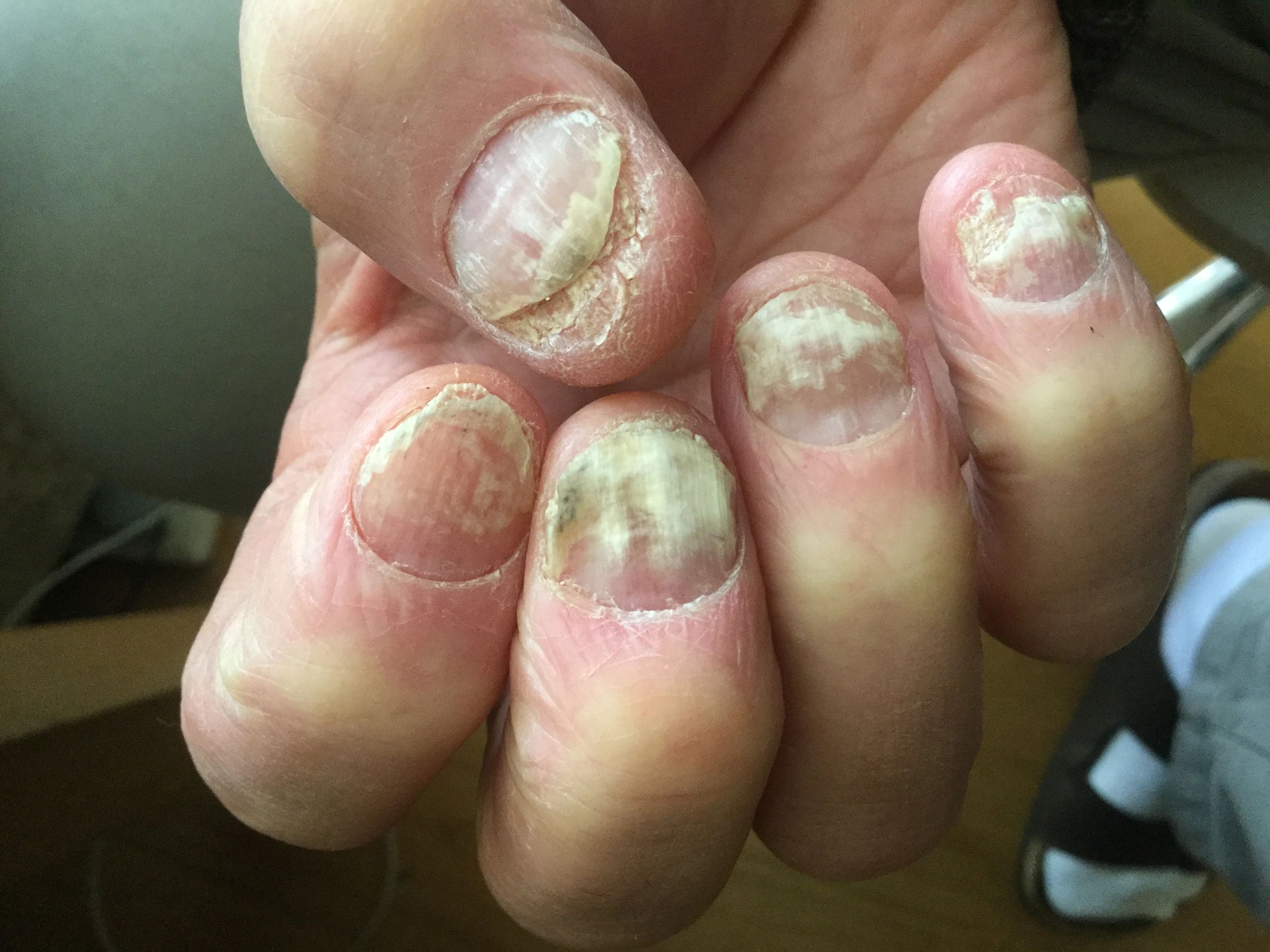 Success Story Of Treating Chronic Diseased Fingernails