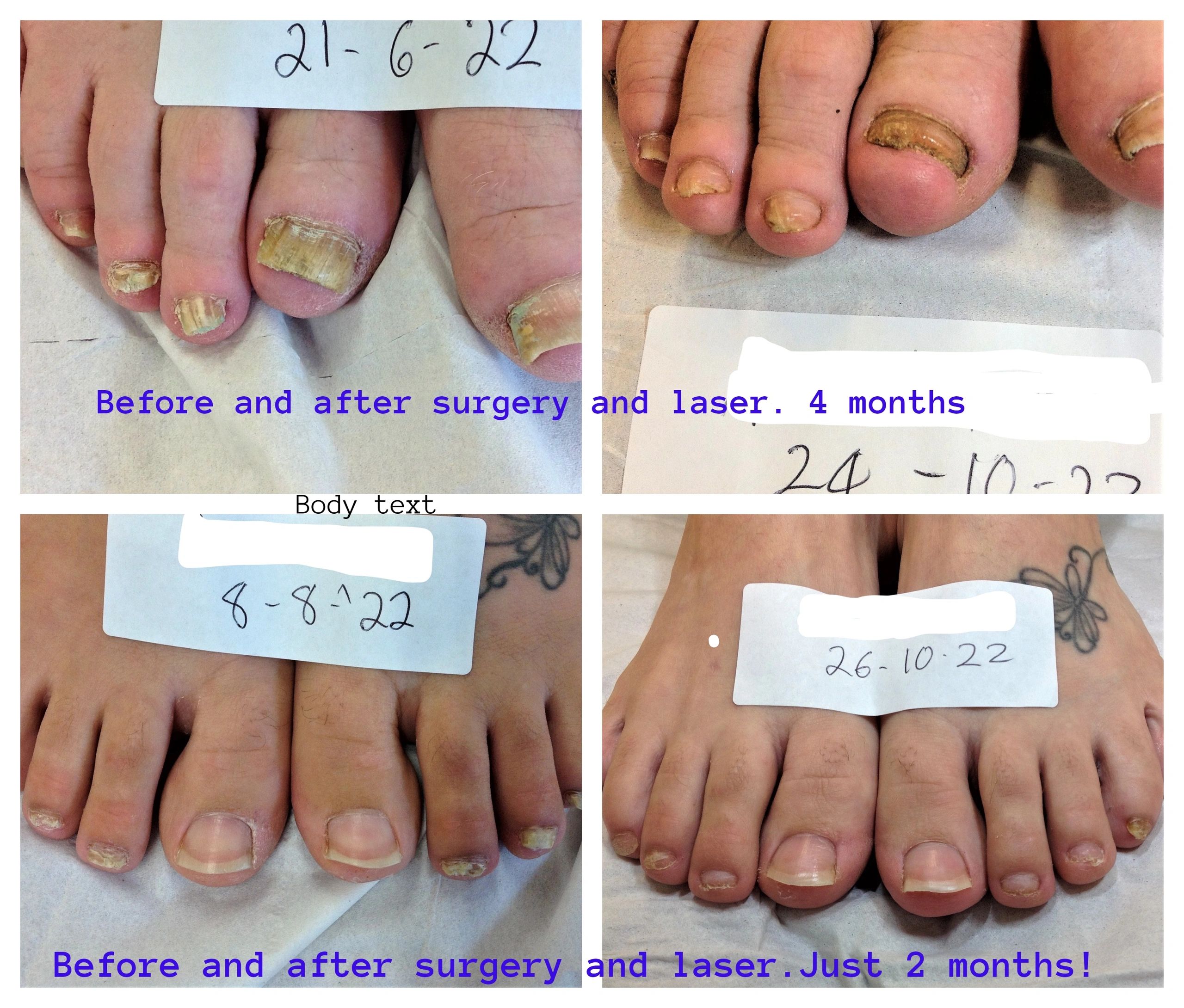 Effective and very fast nail regrowth after surgery and Lunula Effective and very fast nail regrowth after surgery and Lunula
