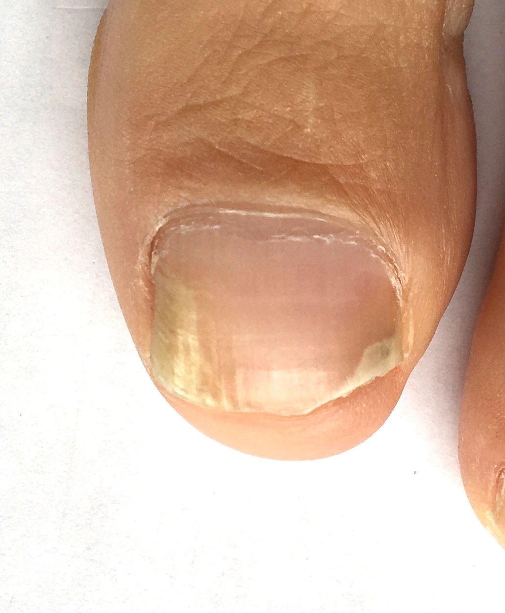 Fungal Nail or Just Damaged?