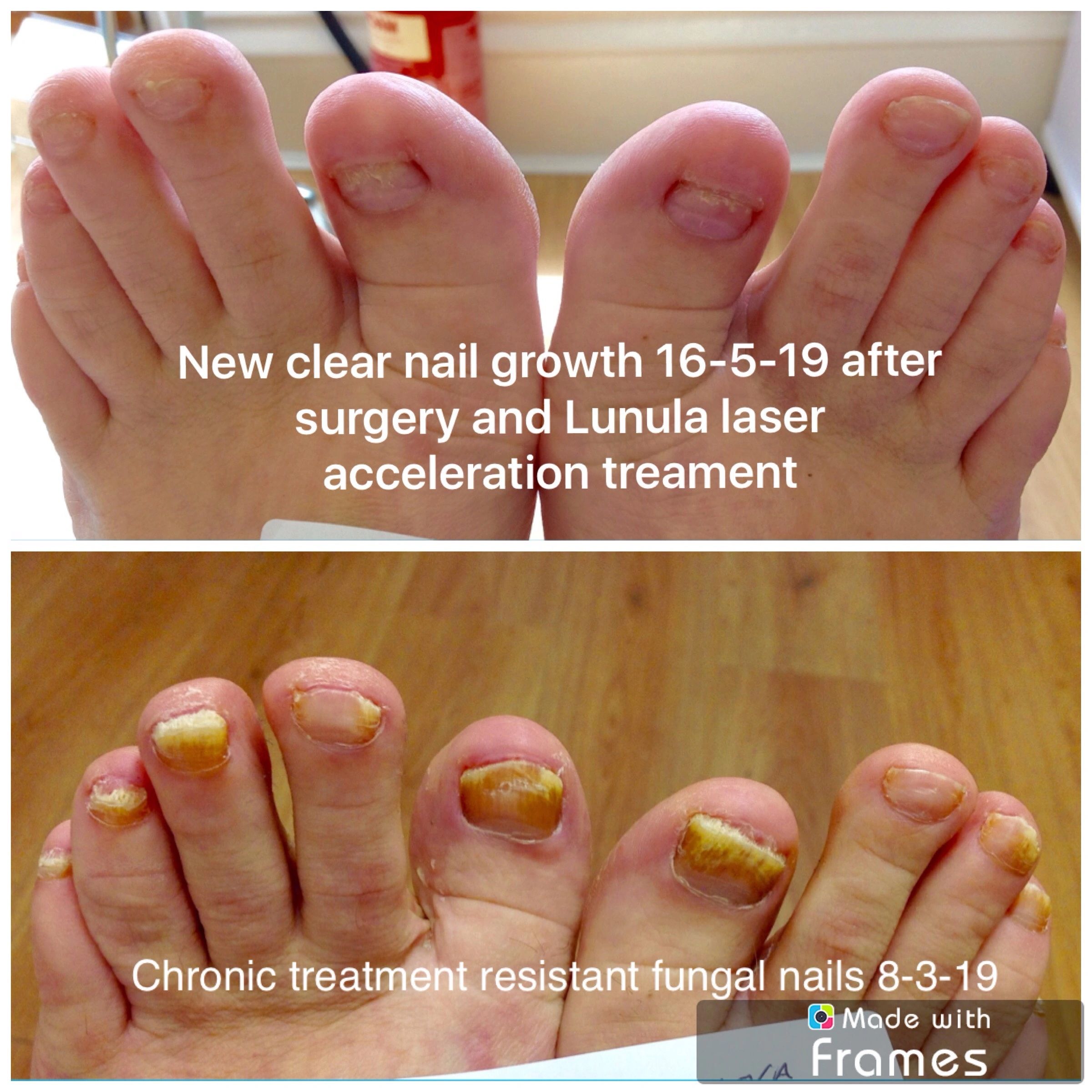 New Best Fungal Nail Treatments. A Tailored Approach.