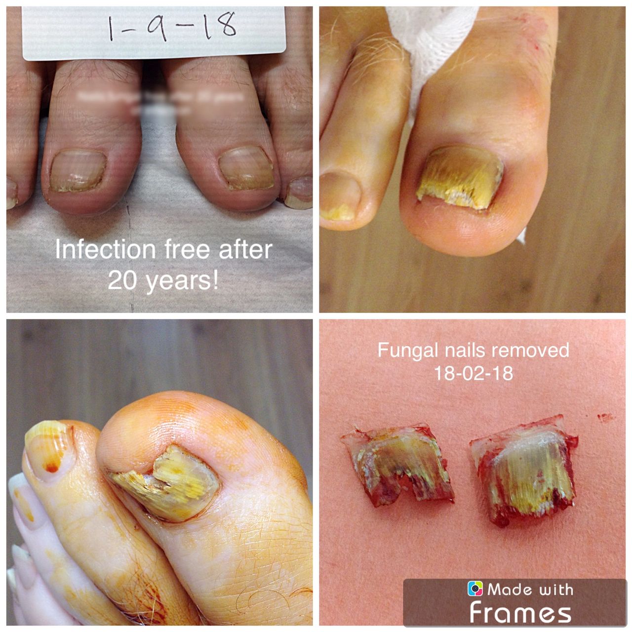 Fungal Nail Infections, Fungal Diseases