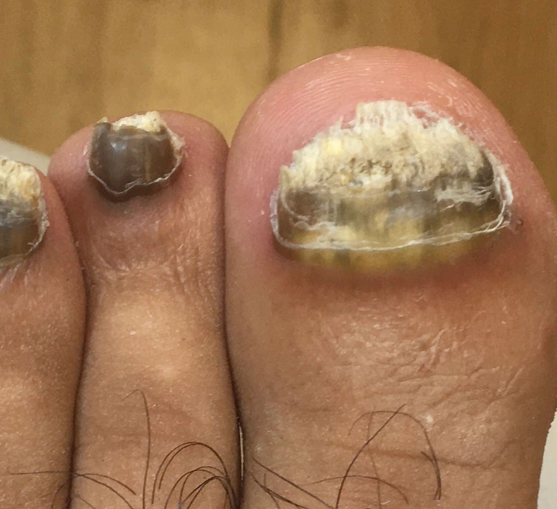 Thick Nails Paint Remove? In clinic with podiatrist Katrina Waller -  Compleet Feet