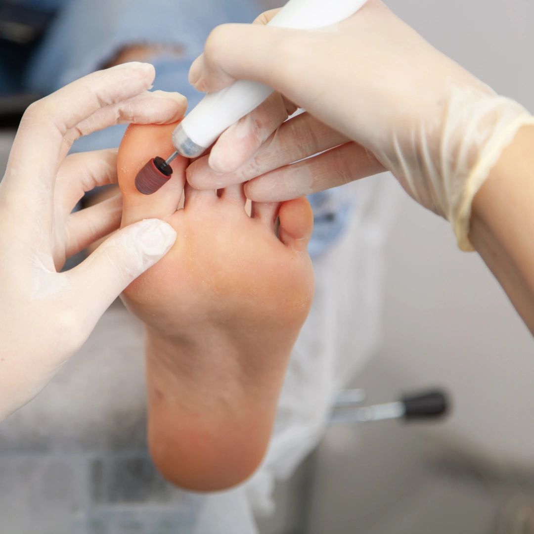 Foot being filed with a drill, removing hard skin and calluses.