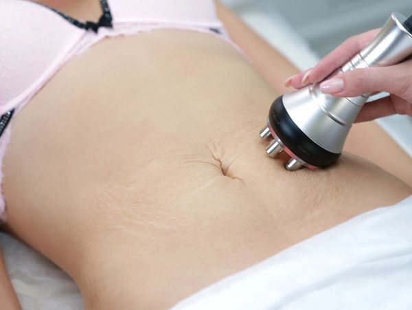 Radio Frequency Treatment tightening Skin on women's stomach