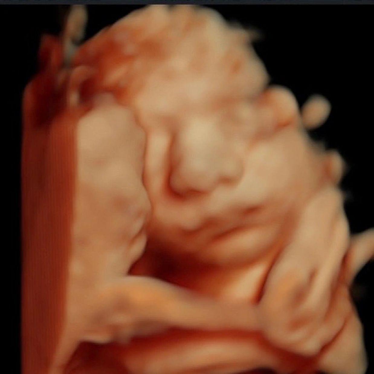 HD LIVE, 5D ultrasound, 3D ultrasound, baby