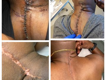 Scar Camouflage with Parmamedical Tattooing