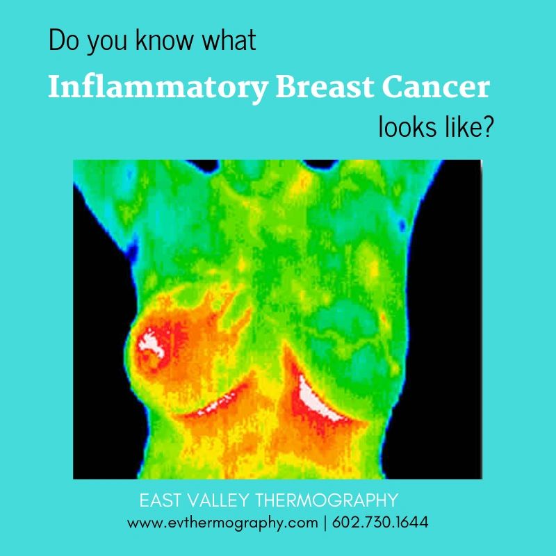 Cleveland Clinic, Inflammatory breast cancer (IBC) is a rare type of  cancer that spreads quickly. Unlike most breast cancers, IBC doesn't  usually cause l