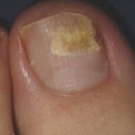 Fungal Nail Infection
Tiny fungi can get inside your nail through a crack or break, causing an infec