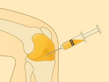 Needle aspiration of yellow joint fluid from knee showing arthrocentesis and injection procedure