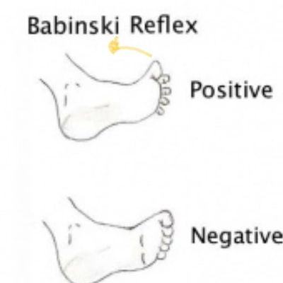 What to Know About the Babinski Reflex