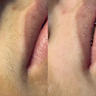 Close-up of skin before and after hair removal, showing smooth transformation.