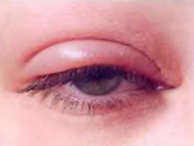 Close-up of an eye with visible redness and blood vessels.