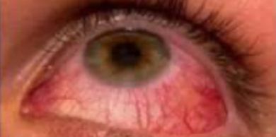 Close-up of an eye with visible redness and blood vessels.