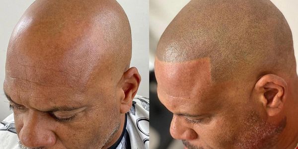 Scalp Micropigmentation - WILLY STYLE SMP Scalp Micropigmentation - WILLY STYLE SMP