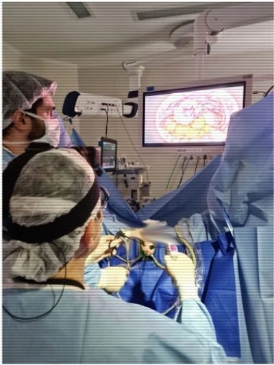 vNOTES surgery Cirurgia vaginal dr Levon Badiglian Filho 