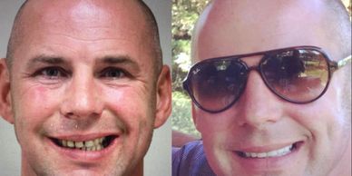 Damon Braces in Bournemouth.  Coupled with dental implants in Bournemouth, a great end result! :)