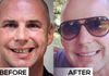 {"blocks":[{"key":"6u5dc","text":"What a difference a smile can make!  This patient (ex special forces) had clear braces in bournemouth to move the teeth into new positions ready for an implant to replace a missing lateral incisor and bonding to improve overall tooth shape (and of course teeth whitening).  total treatment time 12 months.","type":"unstyled","depth":0,"inlineStyleRanges":[],"entityRanges":[],"data":{}}],"entityMap":{}}