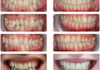 {"blocks":[{"key":"7p09q","text":"Orthodontic Severe crowding resolved with Damon Clear braces in ringwood.  total orthodontics treatment time around 12 months","type":"unstyled","depth":0,"inlineStyleRanges":[],"entityRanges":[],"data":{}}],"entityMap":{}}