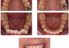 {"blocks":[{"key":"9po4h","text":"Wow, what a difference 4 months makes!  This smile took only 4 months to develop.  The patient was over the moon by then and wanted the braces off.  Subsequent visits the patient has said that her new smile gave her so much confidence that she could take on a training teaching role and is now a full time teacher - amazing what a smile can do!","type":"unstyled","depth":0,"inlineStyleRanges":[],"entityRanges":[],"data":{}}],"entityMap":{}}