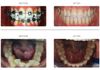 {"blocks":[{"key":"bpk85","text":"Damon Q braces to bring out an incisor that was hiding behind the other teeth!  This journey took under a year with Orthodontics in Ringwood","type":"unstyled","depth":0,"inlineStyleRanges":[],"entityRanges":[],"data":{}}],"entityMap":{}}