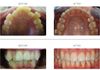 {"blocks":[{"key":"e8db3","text":"Severe crowding treated with Damon Q braces.  This Journey of Orthodontics in Bournemouth took approx. 18 months","type":"unstyled","depth":0,"inlineStyleRanges":[],"entityRanges":[],"data":{}}],"entityMap":{}}