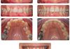 {"blocks":[{"key":"8gfrc","text":"Ever thought of just treating the upper or lower teeth?  This patient wanted to treat just her upper teeth (we left the deep bite as it was and didn't treat the lower teeth at all).  Total Orthodontics treatment time of just 7 months!","type":"unstyled","depth":0,"inlineStyleRanges":[],"entityRanges":[],"data":{}}],"entityMap":{}}