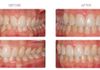 {"blocks":[{"key":"20jhu","text":"Crowding and deep bite treated using Invisalign in Ringwood.  Orthodontic treatment time only 7 months.","type":"unstyled","depth":0,"inlineStyleRanges":[],"entityRanges":[],"data":{}}],"entityMap":{}}