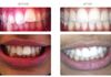 {"blocks":[{"key":"2dc3c","text":"A child refused NHS orthodontics - opted for Invisalign and treated with this form of orthodontics in just 7 months!","type":"unstyled","depth":0,"inlineStyleRanges":[],"entityRanges":[],"data":{}}],"entityMap":{}}