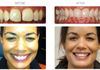 {"blocks":[{"key":"cjbqm","text":"Teeth that stick out.  Treatment time 10 months - Invisalign was used to tuck the teeth in and close the gaps - what a difference it made to this patients profile.","type":"unstyled","depth":0,"inlineStyleRanges":[],"entityRanges":[],"data":{}}],"entityMap":{}}