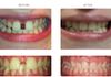 {"blocks":[{"key":"fc4pt","text":"severe gap closure using Invisalign in Ringwood - 7 months total Orthodontic treatment time.","type":"unstyled","depth":0,"inlineStyleRanges":[],"entityRanges":[],"data":{}}],"entityMap":{}}