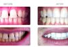 {"blocks":[{"key":"4ea4s","text":"Closing gaps and cosmetic bonding for peg shaped lateral incisors (and Zoom teeth whitening).  Treatment time using invisalign only 7 months!","type":"unstyled","depth":0,"inlineStyleRanges":[],"entityRanges":[],"data":{}}],"entityMap":{}}