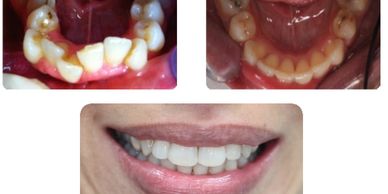 Incognito braces in bournemouth, complex orthodontics in Bournemouth